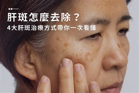 臉頰斑|一次解析曬斑、肝斑、雀斑、顴骨母斑等皮膚黑斑原因…